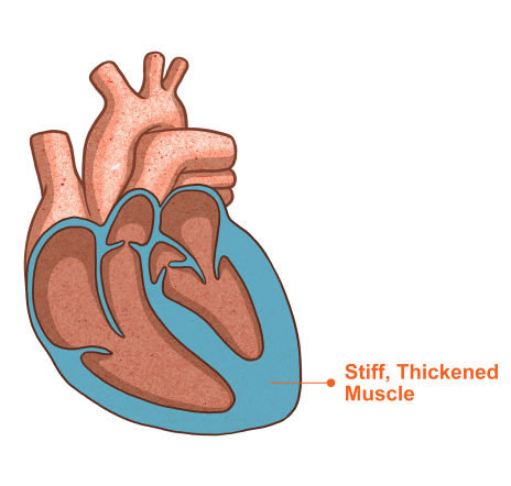 Image of a thickened heart muscle